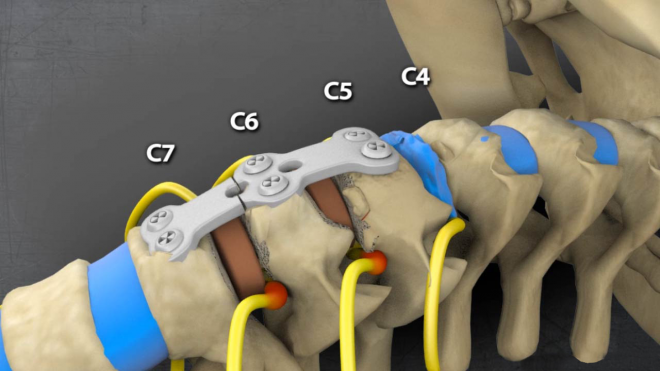 Multi Level Cervical Fusion