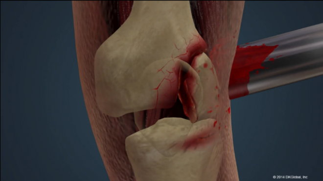 $2,950,000 Settlement - Man Crushed by Cement Truck