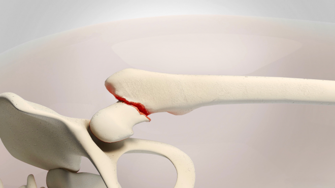 A Woman Undergoes an Invasive Surgery to Repair Broken Femur