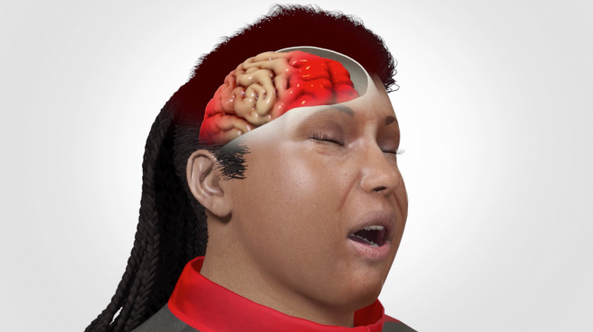 Slip and Fall Case Secures Million Dollar Settlement