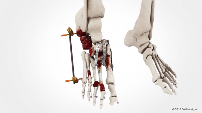 $750K Obtained for Man’s Foot Crushing Trauma