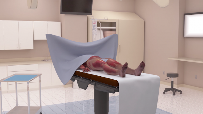 Skin Graft Procedure Animated