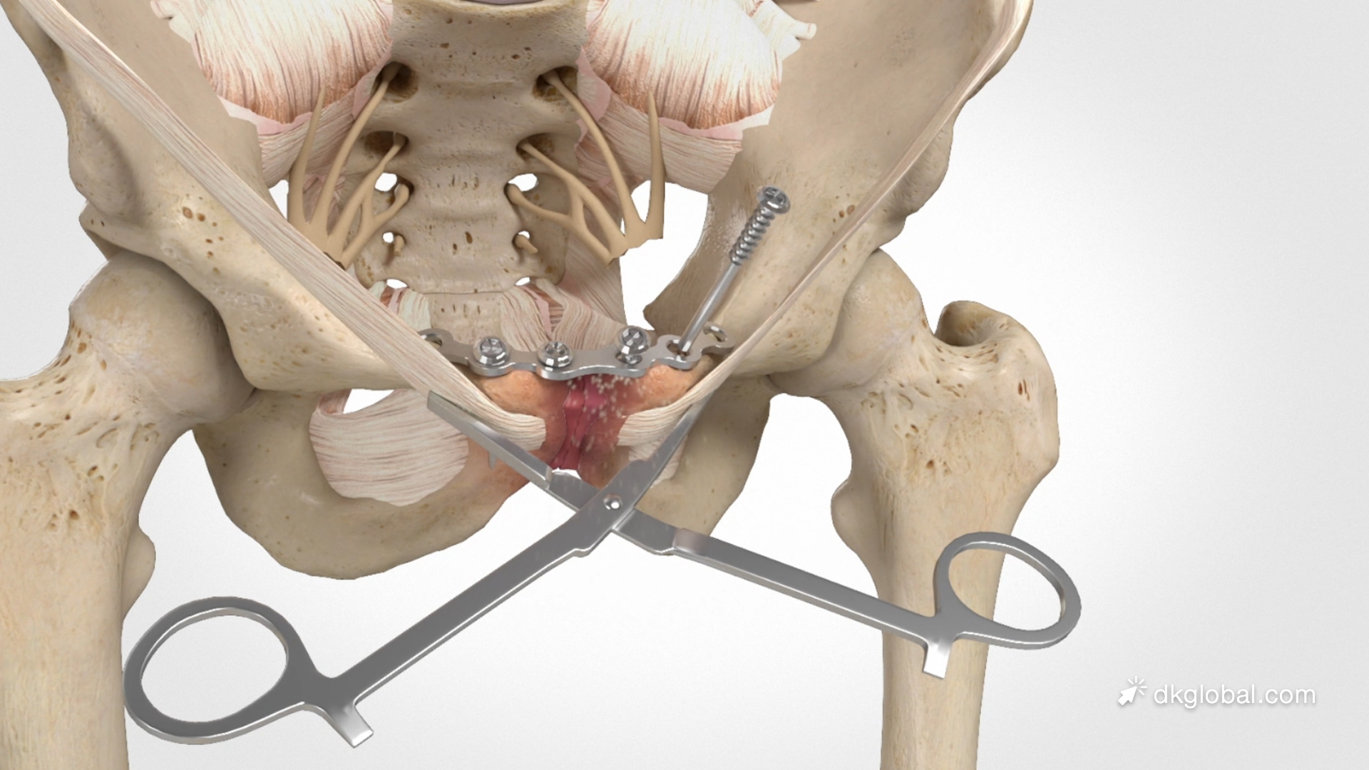 Open-Book Pelvic Fracture for Motorcyclist After Driver Fails to Yield at Left Turn