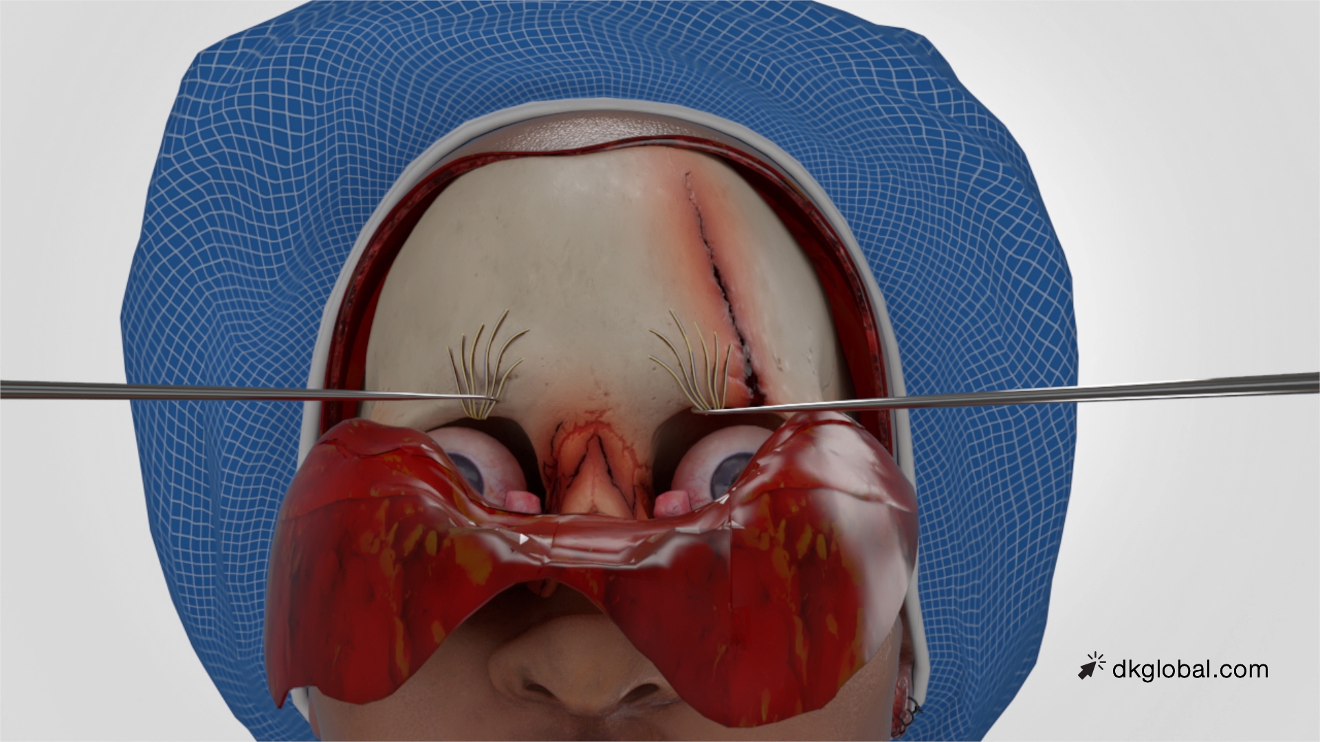 Horrific Underride Collision Required Face Peeling to Repair Fractures
