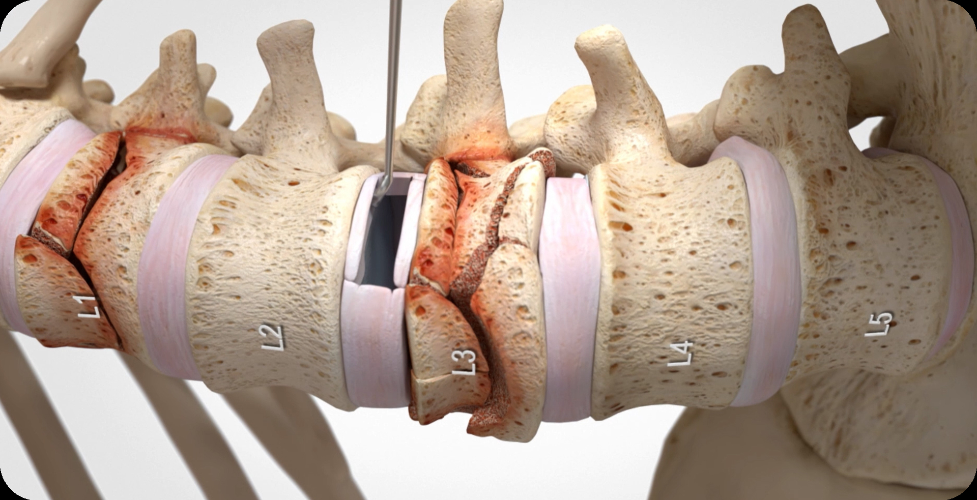 Exterminator Requires Spinal Fusion Following 12-Foot Fall Through Mezzanine Floor