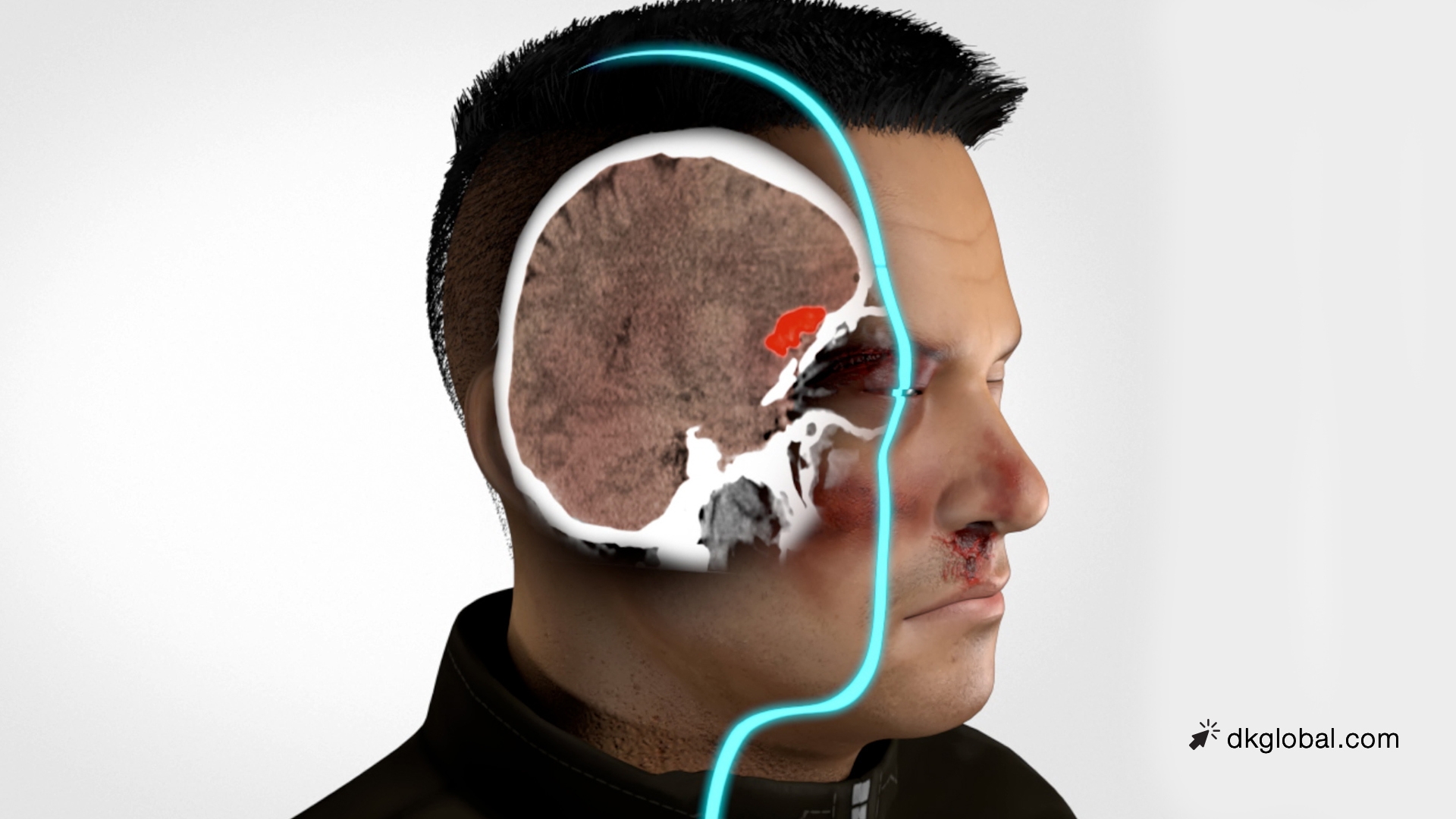 Bus Driver’s Reckless Left Turn Leaves Young Biker with Severe Brain and Facial Injuries