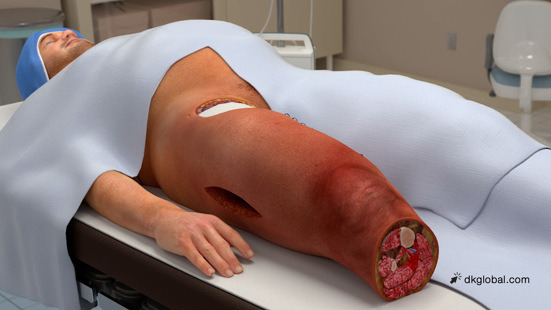 Malpractice Victim Suffered 3 Amputations, 14 Surgeries, and 315 Days in Skilled Nursing