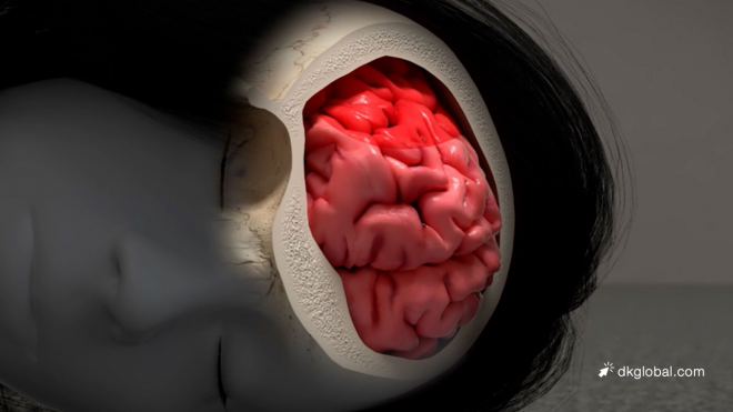 Student Suffers TBI, Seizures, and Permanent Deficiencies from Fallen Metal Beam