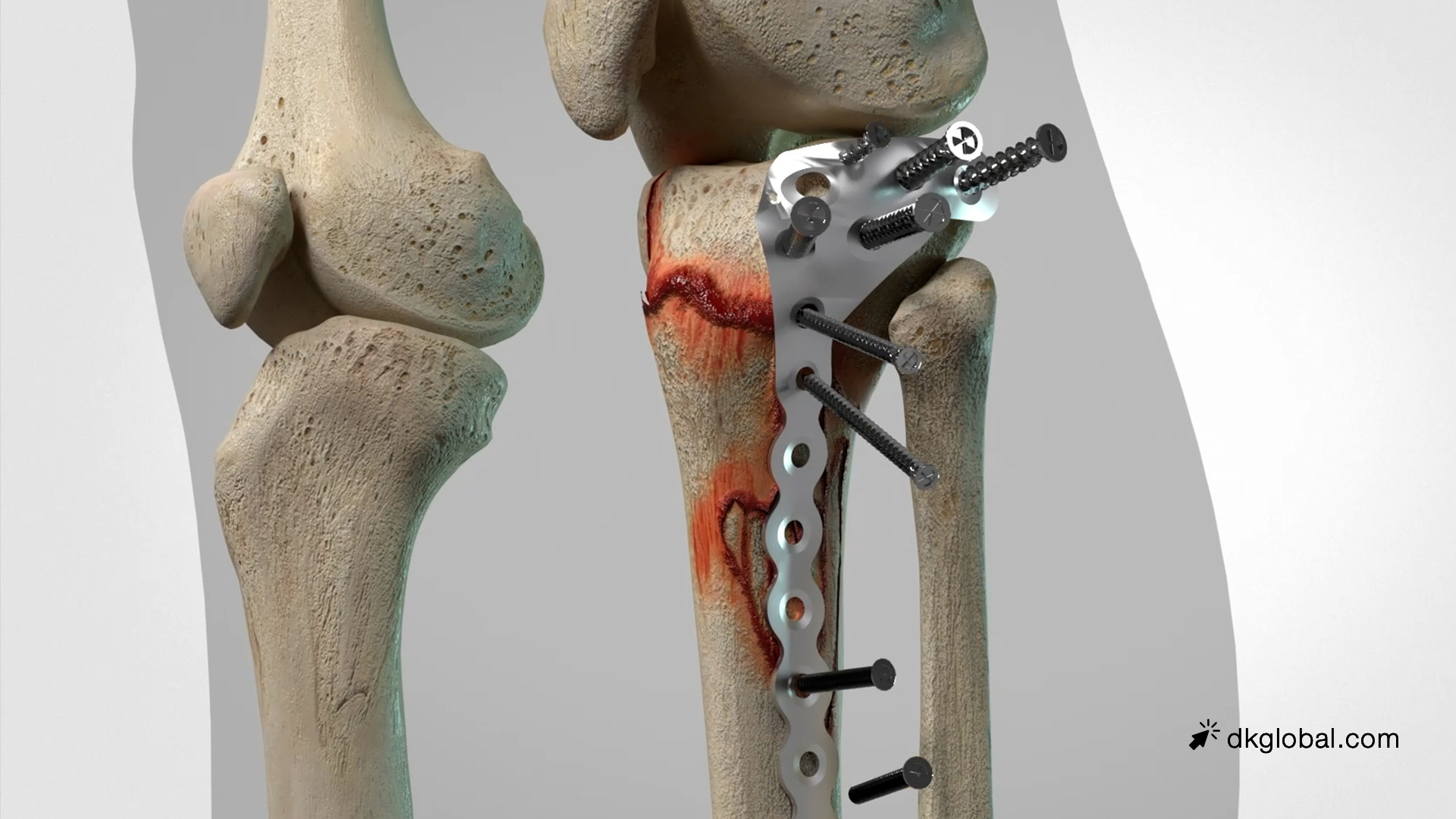 Manufacturer and Dairy Farm Neglected Milking Machine That Led to Worker’s Maimed Leg
