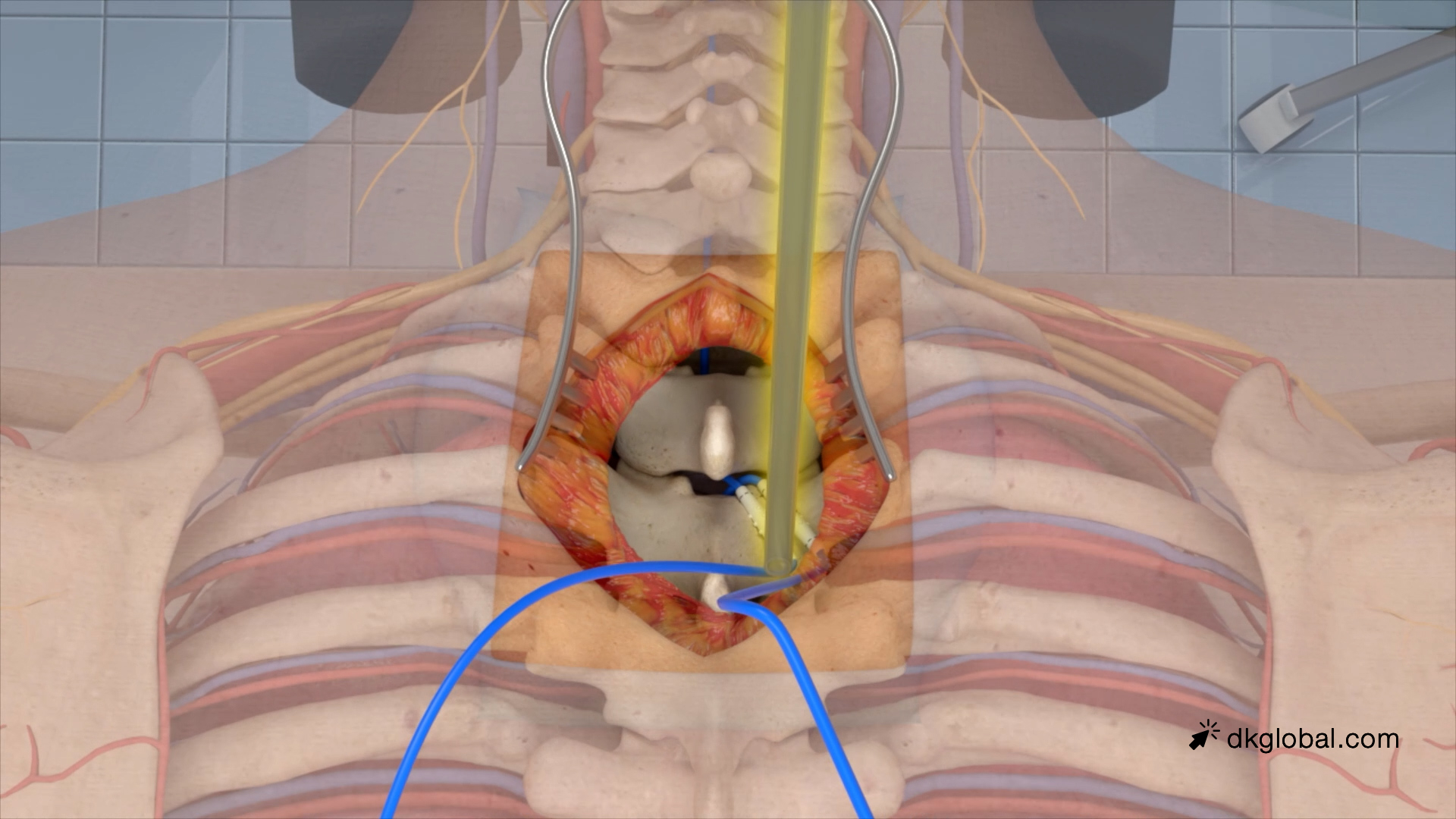 Construction Worker Survives 23-Foot Fall but Suffers Lifelong Complex Regional Pain Syndrome