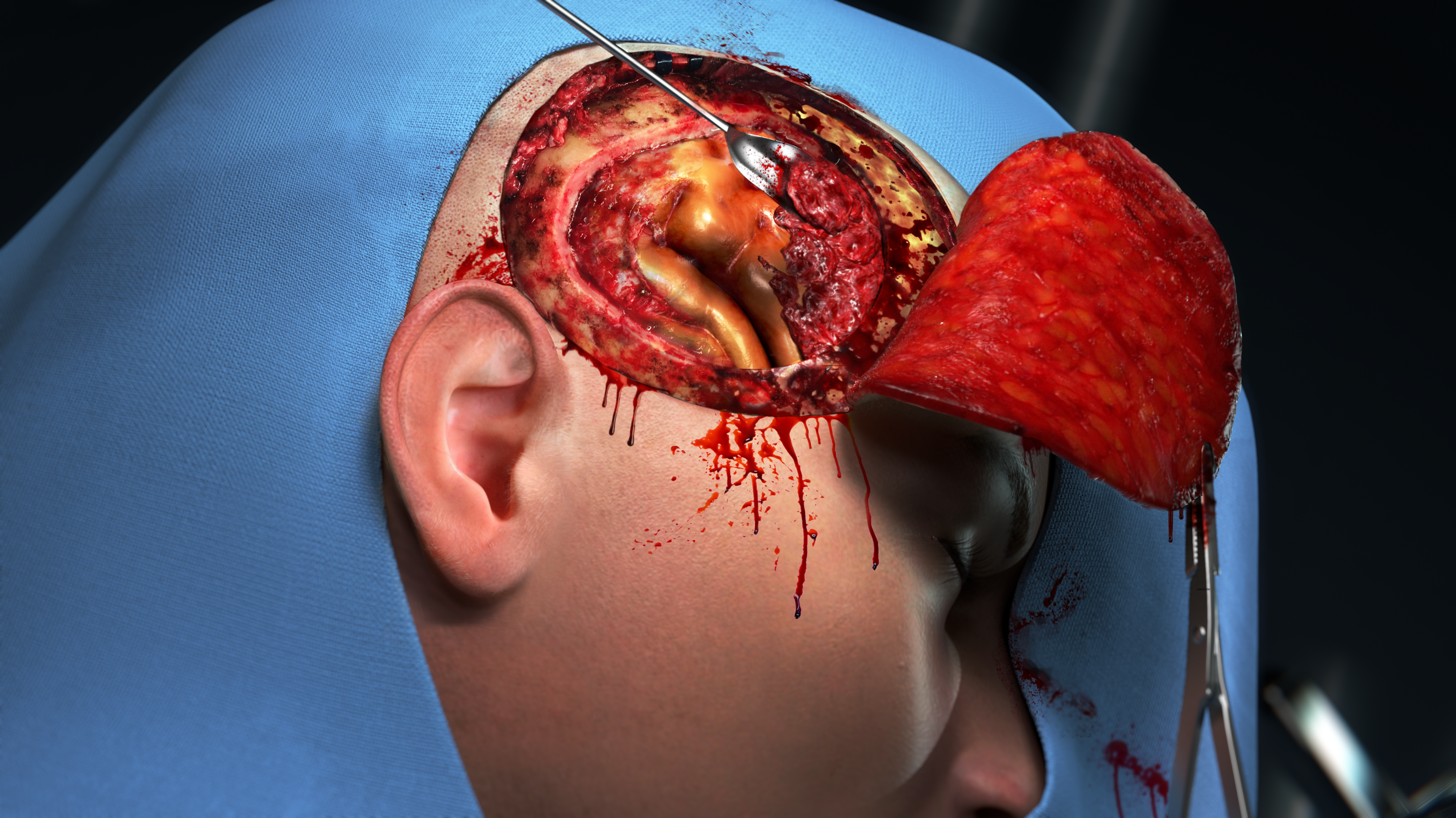 finished craniotomy visual finished craniotomy visual