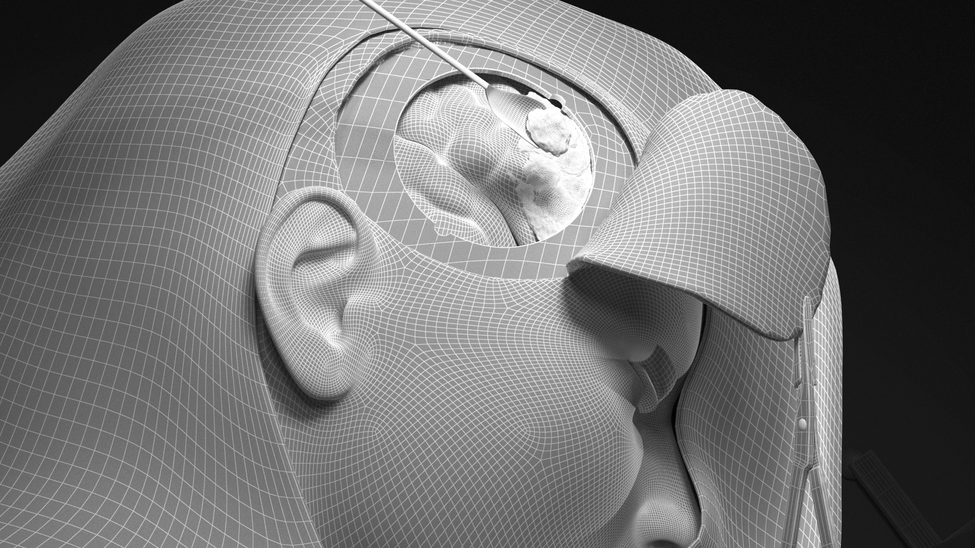 the digital framework of craniotomy depiction the digital framework of craniotomy depiction