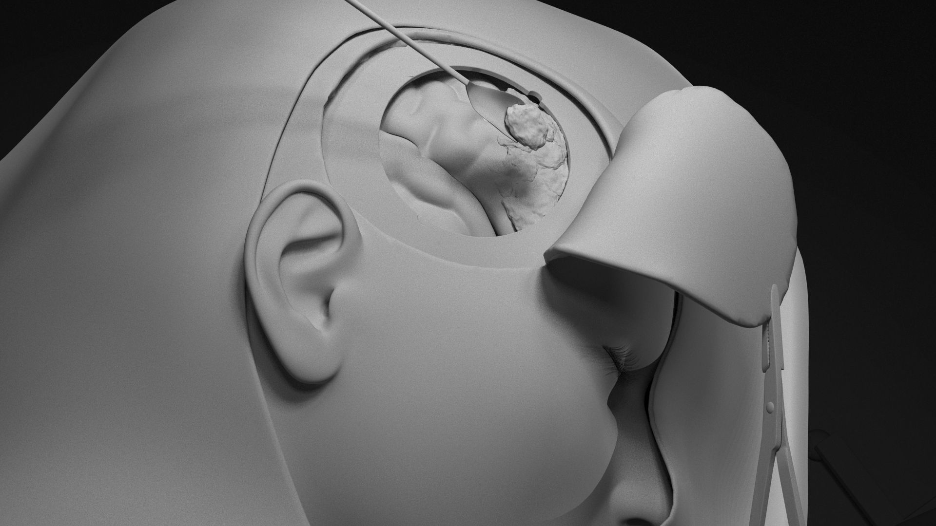 craniotomy with no texture craniotomy with no texture