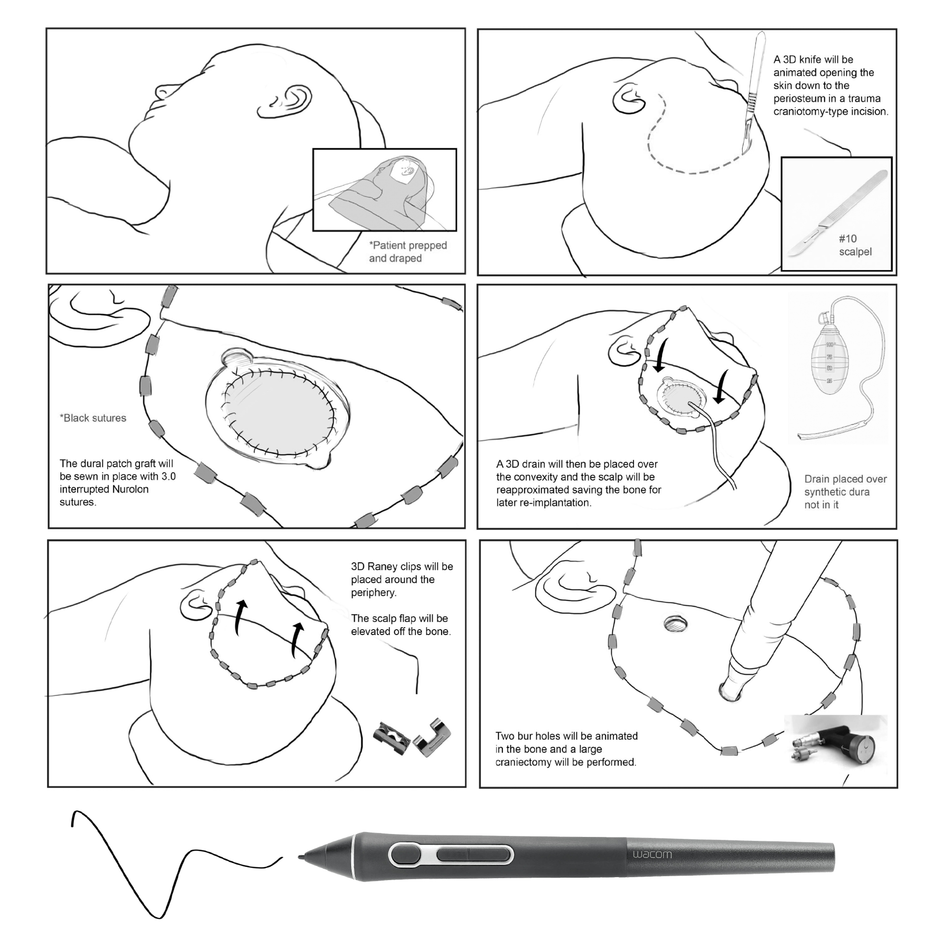 Craniotomy Sketch Craniotomy Sketch