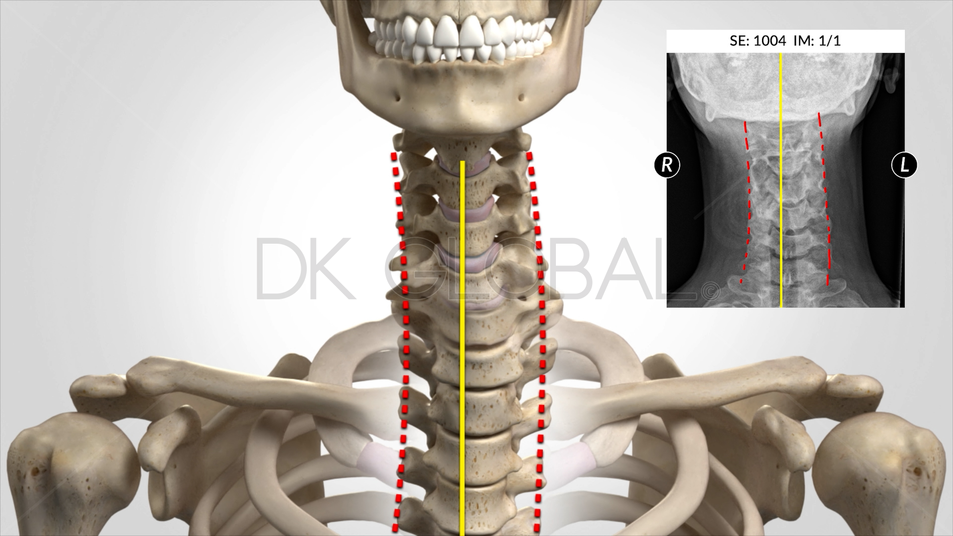 Car Crash Neck Displacement Injury crash injury neck displacement