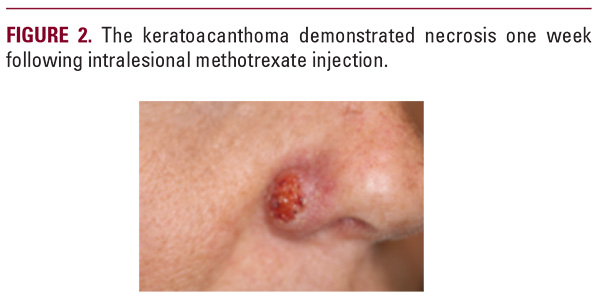 Keratoacanthoma