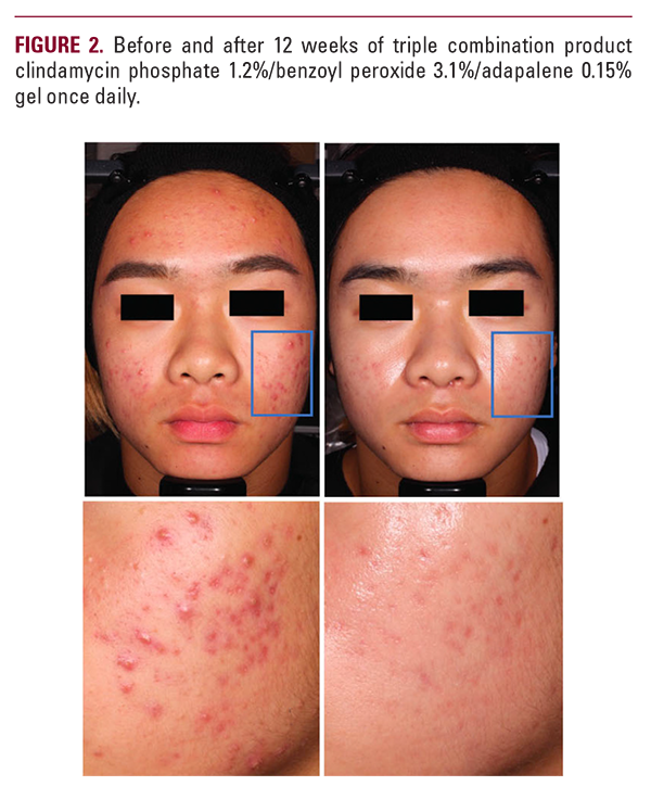 INDIVIDUAL ARTICLE: Pathophysiologic Targets of Acne Treatment ...