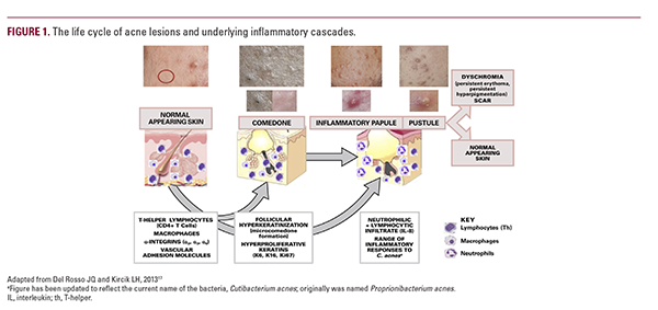 Topical Clindamycin in the Management of Acne Vulgaris: Current ...