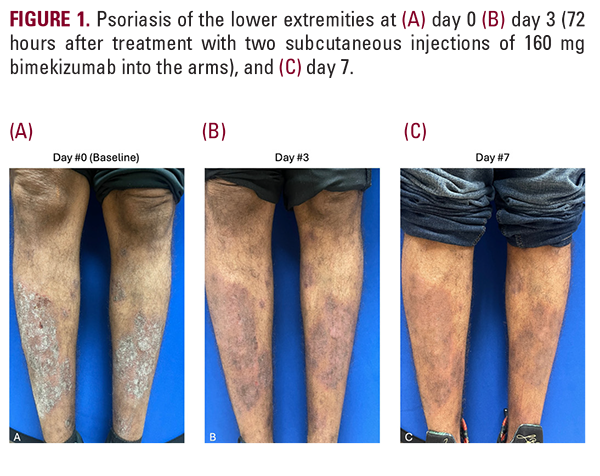 Psoriasis Remicade Rash Rapid Remission of Plaque Psoriasis With Bimekizumab Treatment ...