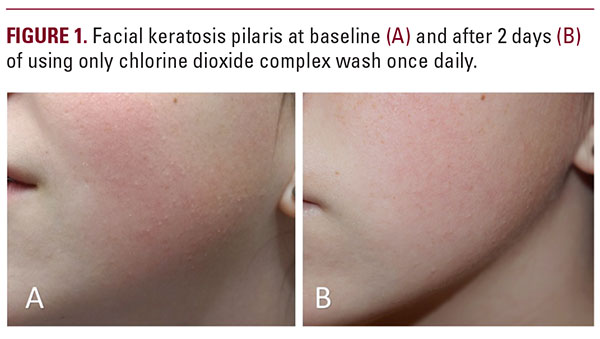 can glutathione help keratosis pilaris Keratosis Pilaris Treatment for Darker Skin Types main image 1