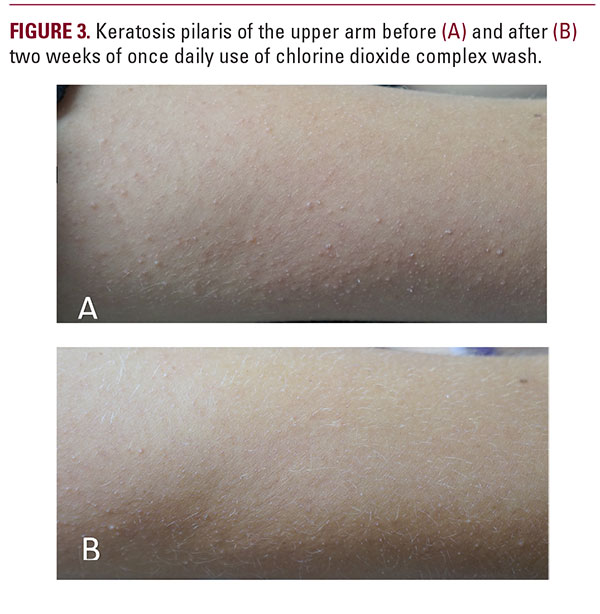 Chlorine Dioxide Complex Cleanser: A New Agent With Rapid Efficacy for Keratosis Pilaris - JDDonline - Journal of Drugs in Dermatology Chlorine Dioxide Complex Cleanser: A New Agent With Rapid Efficacy for Keratosis Pilaris - JDDonline - Journal of Drugs in Dermatology