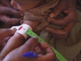 ETHIOPIA / MALNUTRITION