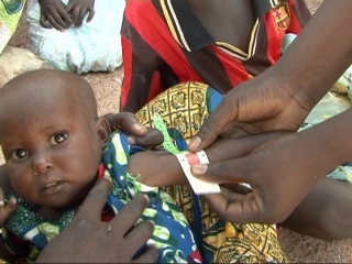 CAMEROON / MALNUTRITION