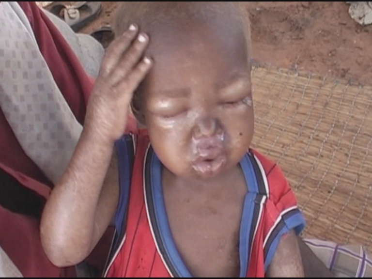 SOMALIA / FAMINE 