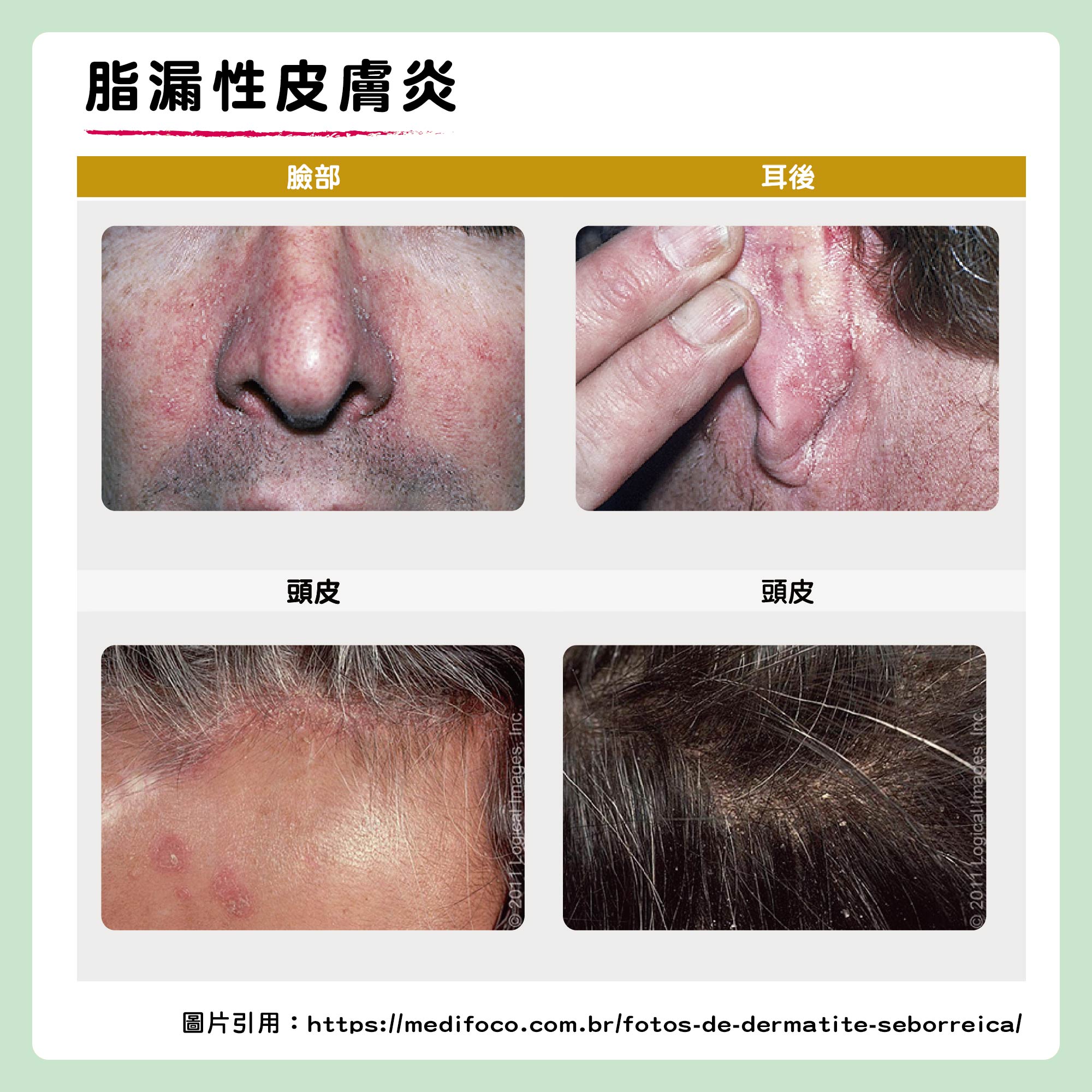 頭皮 性 画像 漏 皮膚 炎 脂