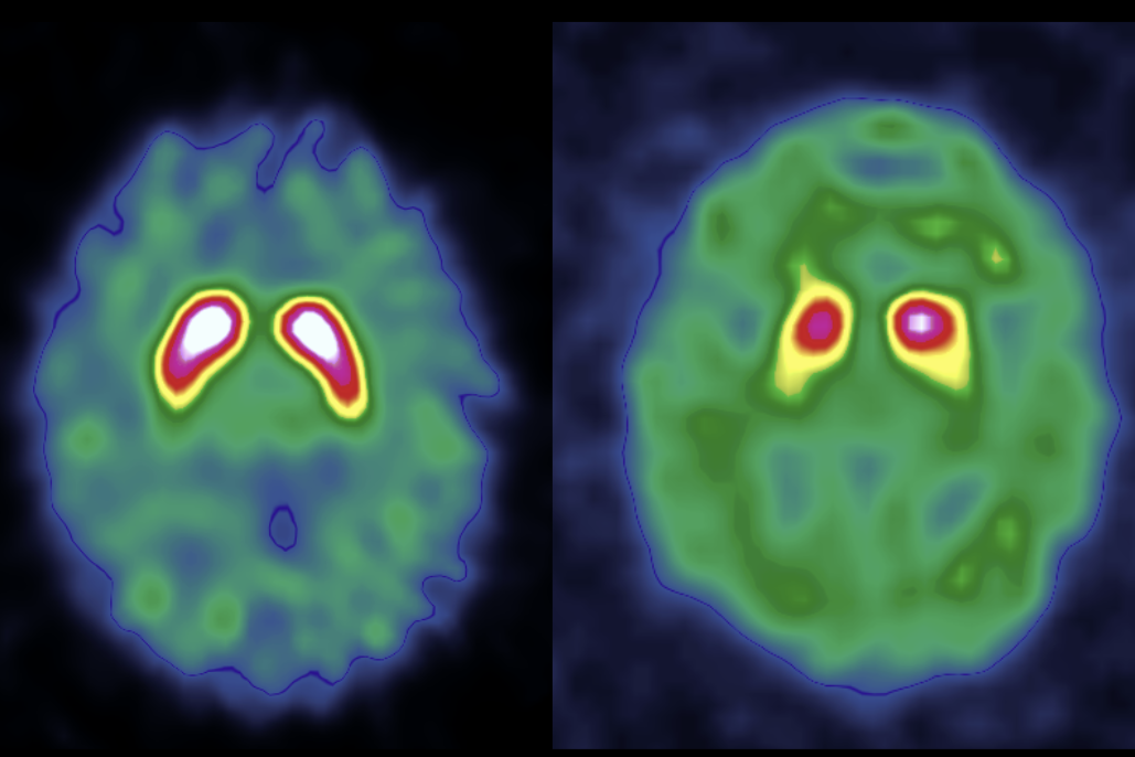 A normal DaT scan on the left and a pathological DaT scan on the right