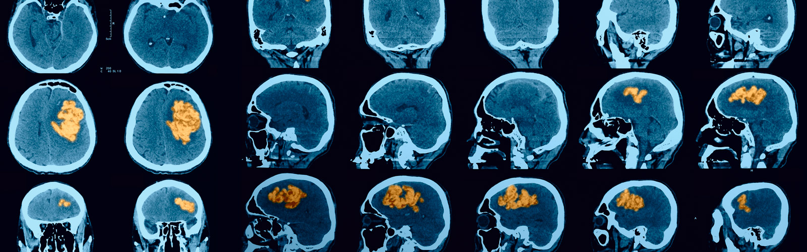 Entrenamiento para la recuperación cognitiva tras un ictus