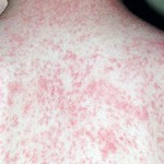 Make sure measles immunizations are up to date