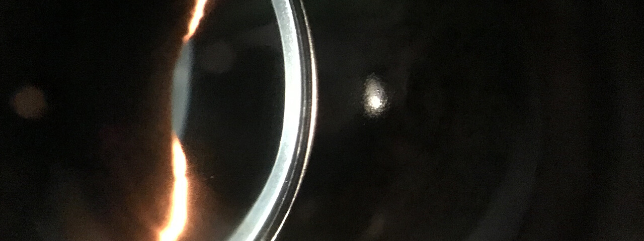 What are Scleral Lenses & How Can they Help Me?