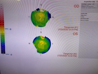 Corneal topography map