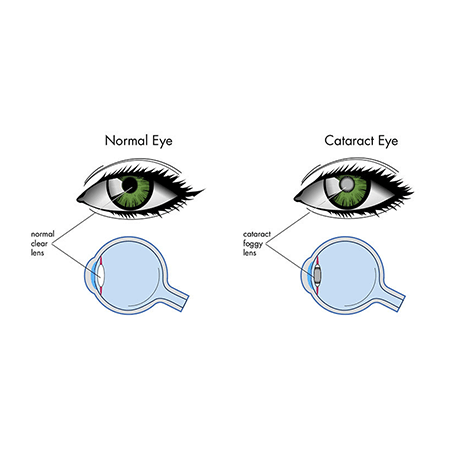 cataract eye crossection