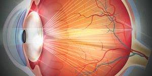 Eye Gallery Catarcts 300x150