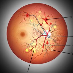 Eye Gallery Diabetes 1.jpg
