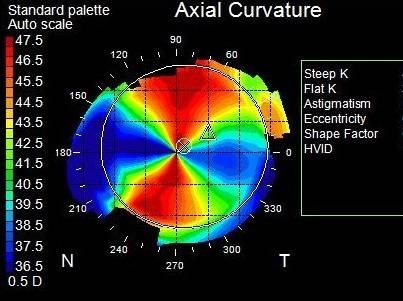 Topography High Astigmatism