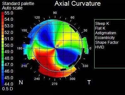 Topography Irregular Astigmatism