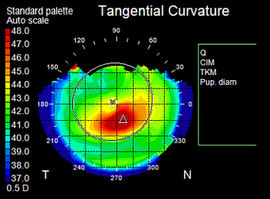Topography Keratoconus 2