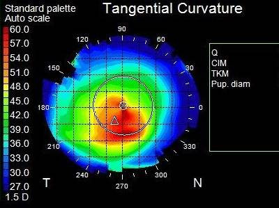 Topography Keratoconus