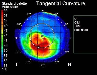 topography keratoconus 3