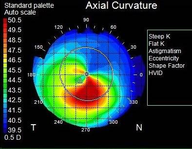 topography keratoconus 6