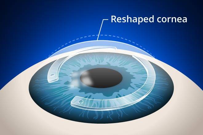 intacs for keratoconus treatment in San Leandro,Concord & Castro Valley, CA.