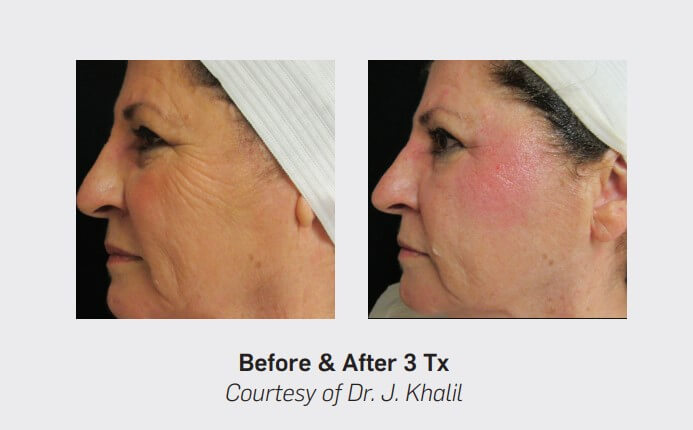 Before and After Comparison of a womans face