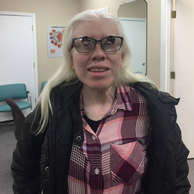 albinism patient wearing low vision glasses
