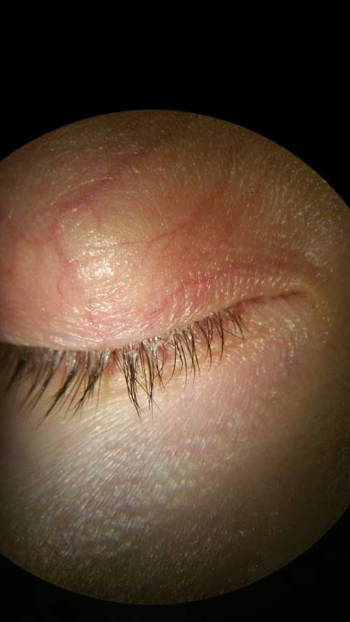 blepharitis1