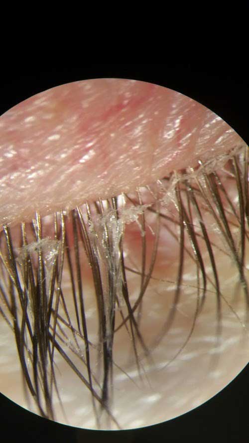 blepharitis2