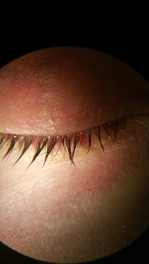 blepharitis3