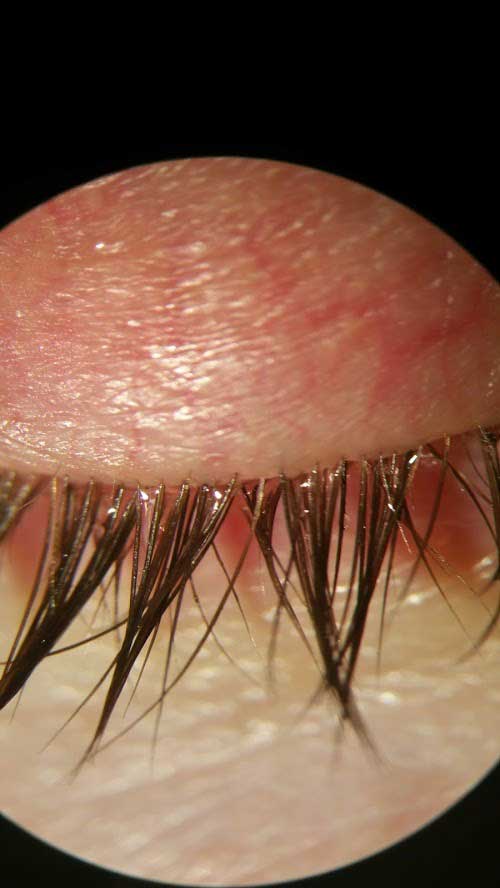 blepharitis4